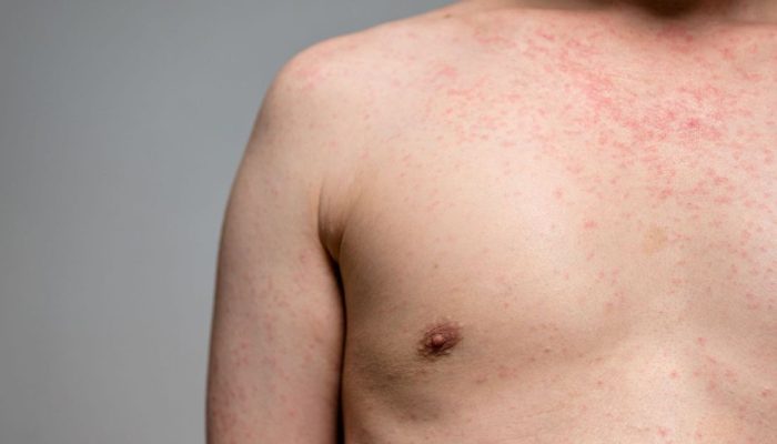 Manchas vermelhas na pele são sintomas de sarampo  • Mumemories/GettyImages